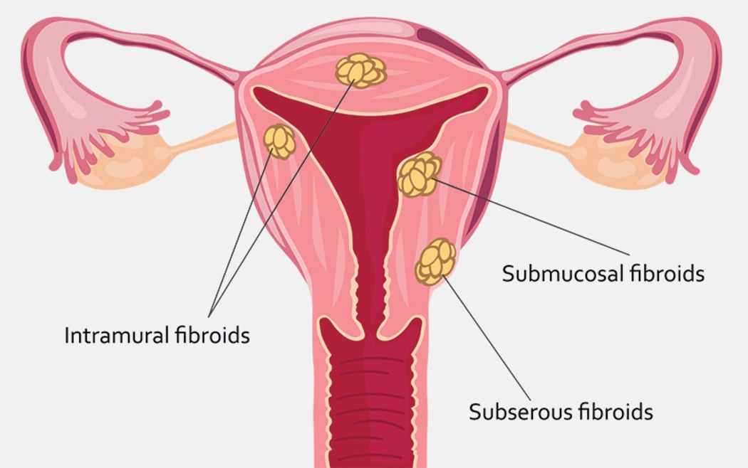 Advanced Fibroid Surgery in Chennai – Get Expert Care at Firm Hospitals, Anna Nagar