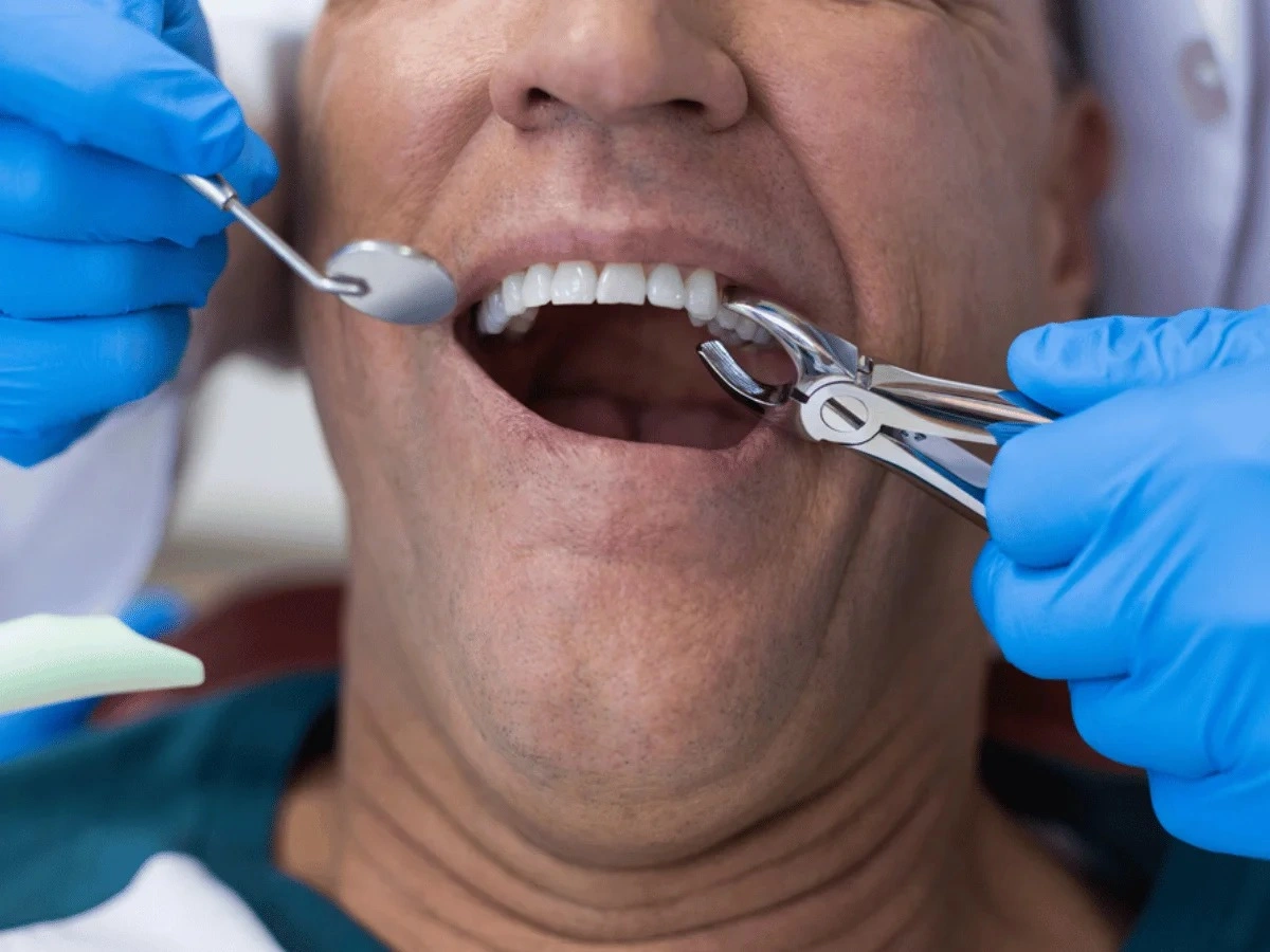 Dental Sealents Milton | Smilelounge.ca