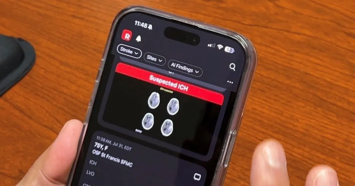 OSF HealthCare expands RapidAI stroke detection across 18 hospitals to speed triage and treatment